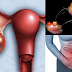 Be Aware Of The Signs And Symptoms Of Ovarian Cancer