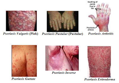 Jenis-jenis Psoriasis 