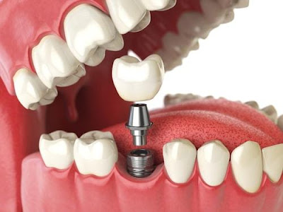 Quy trình cấy răng Implant