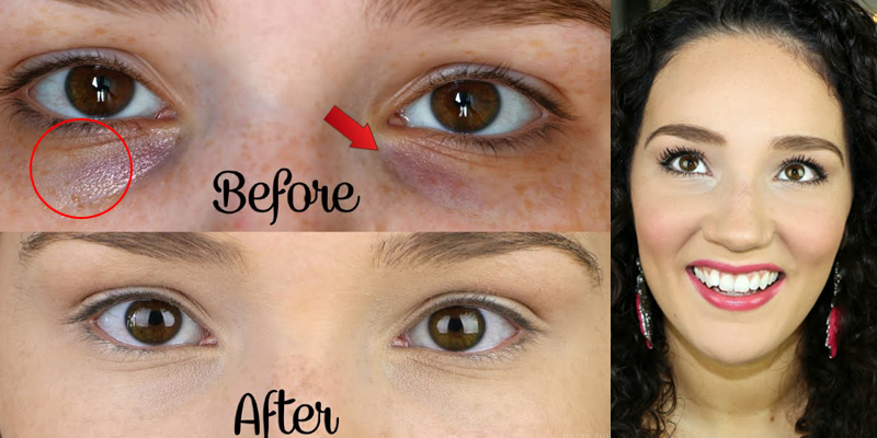 get rid of dark circles very fast at home by using natural get rid of dark circles very fast at home by using natural