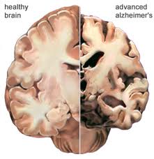 dementia alzheimer mal help