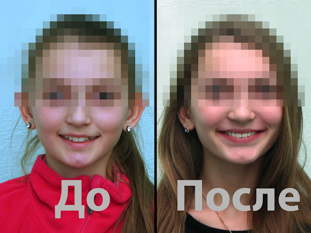 Улыбка пациента до и после лечения брекетами. Фото лица пациента до и послелечения брекетами