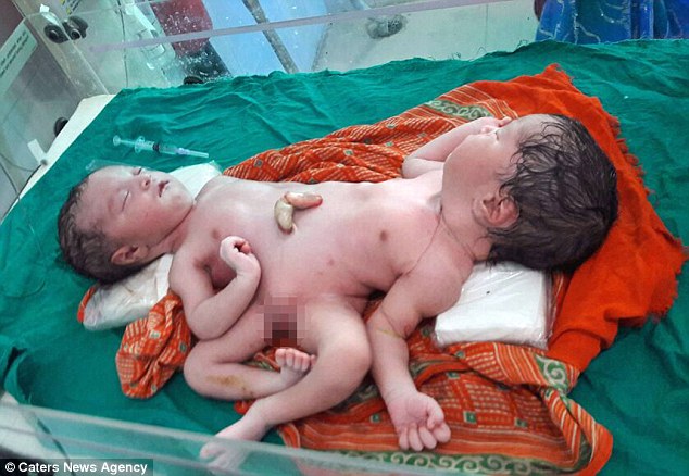 An Indian mother has given birth to conjoined twins who have two sets of ha...