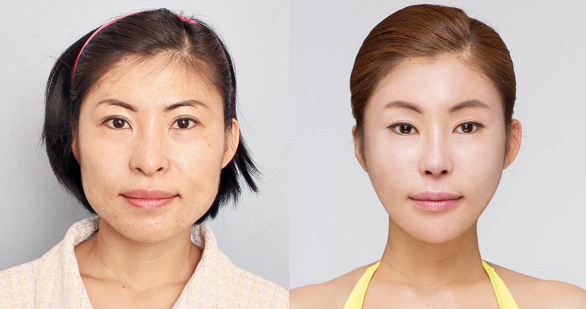 how long does botox last rome fontanacountryinn com how long does botox last