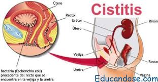 cistitis (infeccion urinaria)