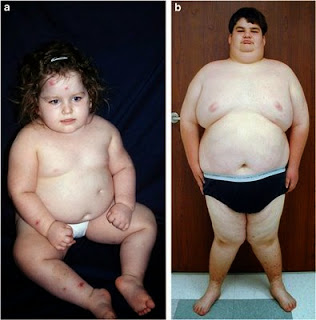obezitate genetica