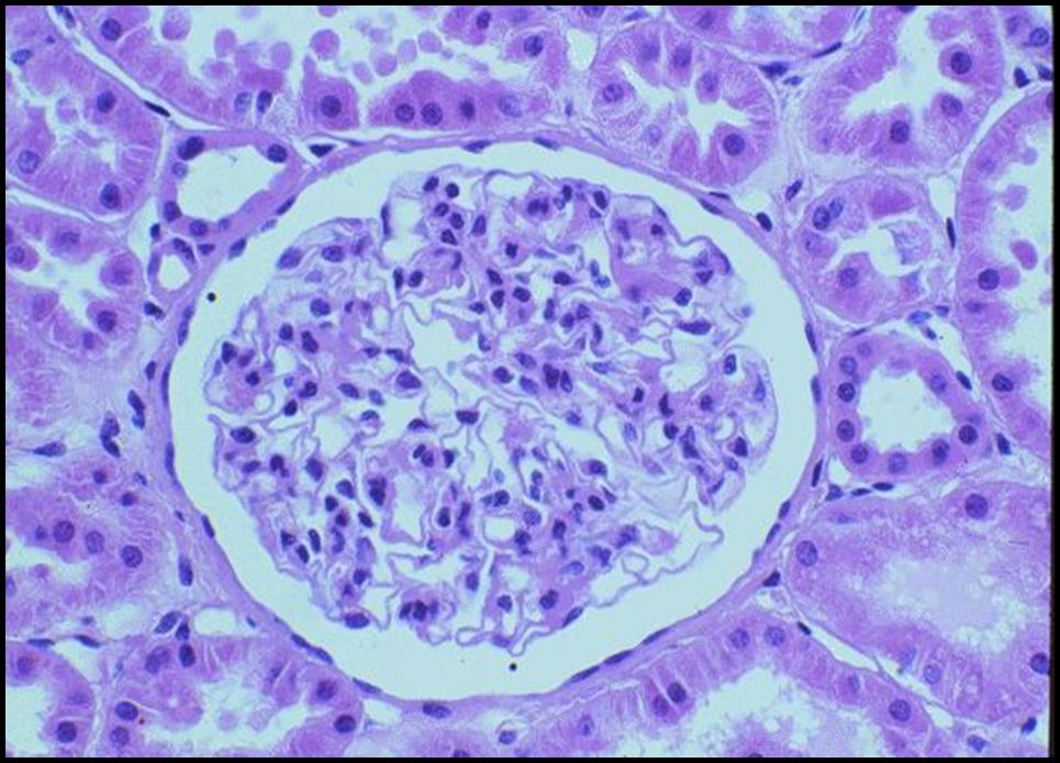 glomerulonefritis fibrilar emedicina diabetes glomerulonefritis fibrilar emedicina diabetes