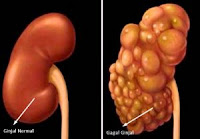 obat gagal ginjal obat herbal alami gagal ginjal