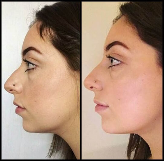 NonSurgical Nose Job Using Dermal Fillers Dubai, Abu Dhabi Dubai
