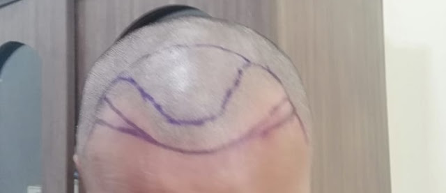 Drawing to address the male bald pattern
