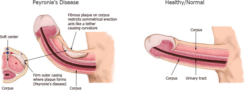 The Effects Of Diabetes In Men Sex Health Healthy Living