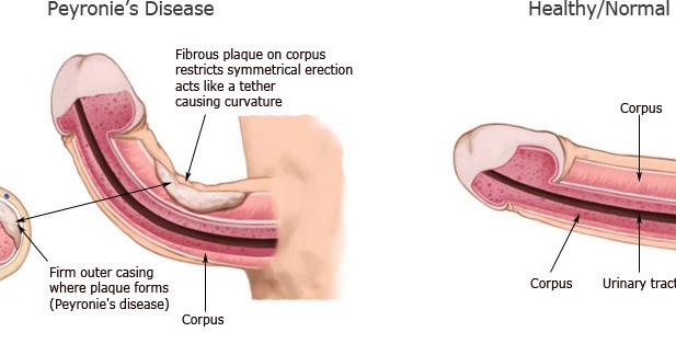 diabetes and male sex problems diabetes and male sex problems
