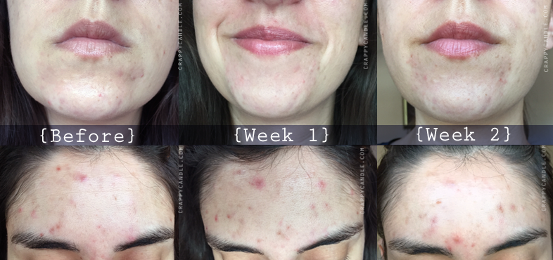 St. Ives Exfoliating Pads Before and After - The Acne Experiment