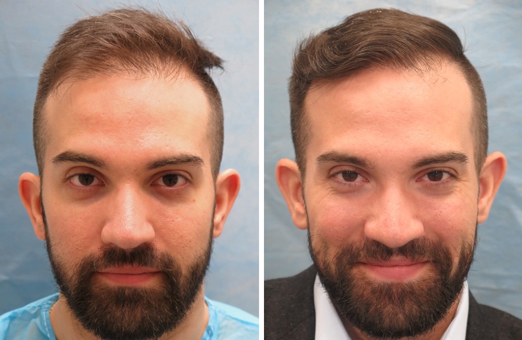 Hair Transplant Vs Medication What S Right For Me