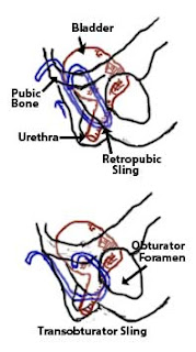 sling procedure for urinary incontinence