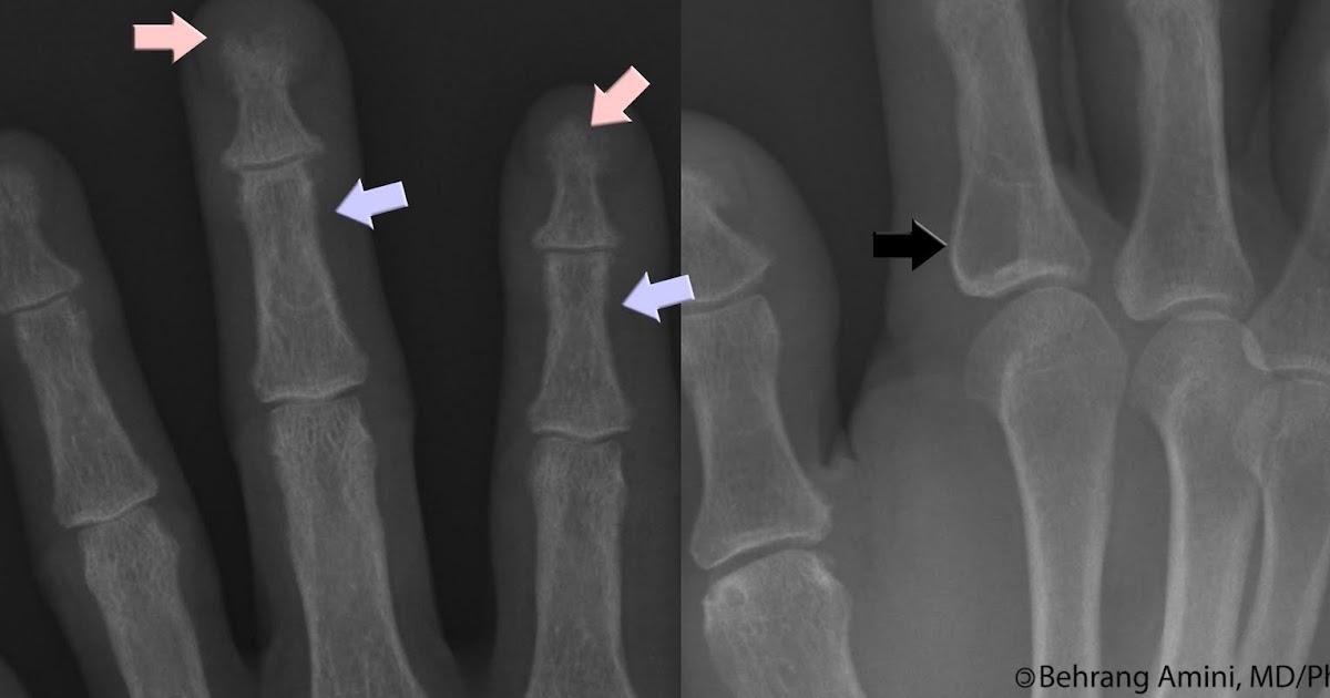 Roentgen Ray Reader: Radiographic Features of Hyperparathyroidism