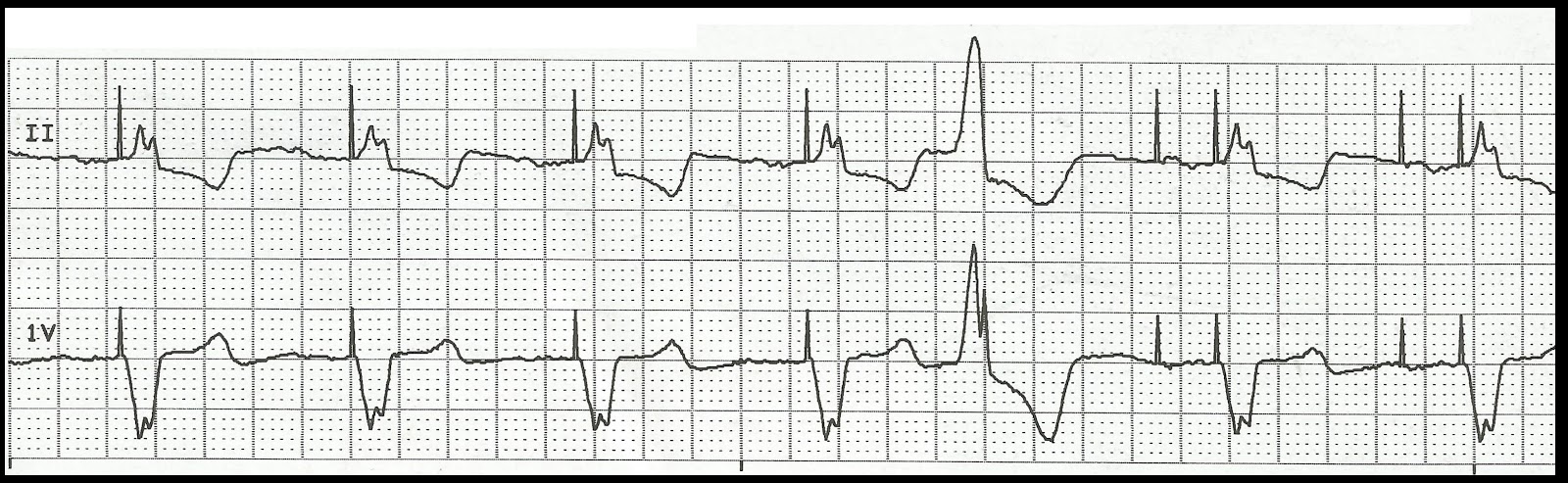 Practice EKG Rhythm Strips 132