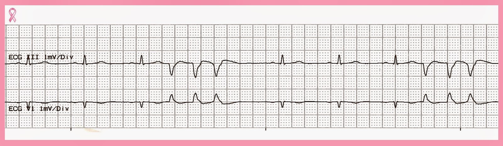 Practice EKG Strips 357