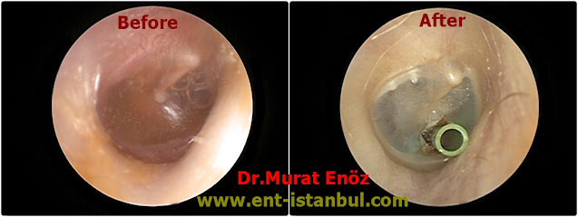 Indiciations of Ventilation Tube Operation - Ear Ventilation Tube Operation - Grommet Insertion Animation - Ventilation Tube (Grommet) Insertion Video - Ear Ventilation Tube Insertion in Istanbul - Ear Tube Insertion in Istanbul - Ear Ventilation Tube Insertion in Turkey