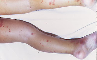 immune thrombocytopenic purpura