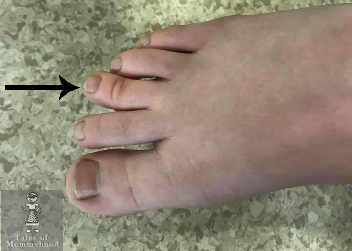toe hitting top of shoe
