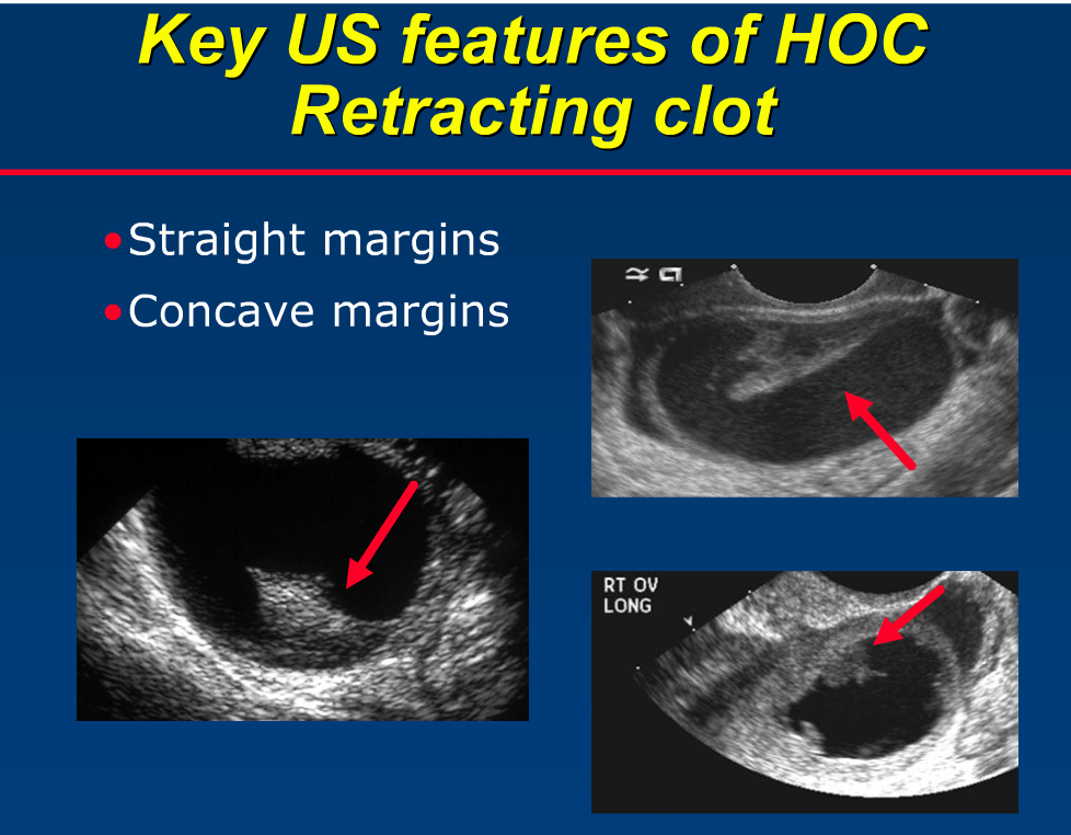 rsna hemorrhagic ovarian cyst