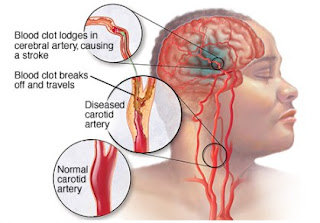 Manfaat Daun Karet Kebo Untuk Stroke gambar daun karet kebo, cara mengolah daun karet kebo, manfaat daun karet kebo bagi kesehatan, karet kebo untuk stroke, cara merebus daun karet kebo