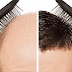 تعاني من تساقط الشعر؟ زراعة الشعر حل فعال لكن له مخاطره