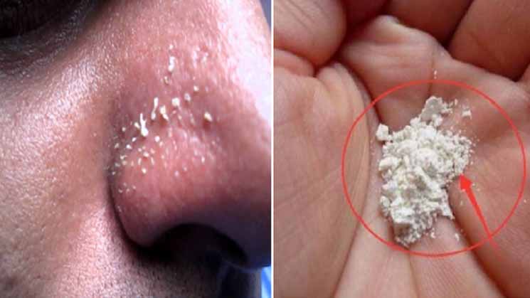 Komedo Menyebakan Susah Hilang? Ini Dia 4 Tips Super Ampuh Banget Usir Komedo Bikin Wajah Mulus dan Harus! Bye-bye Komedo... Komedo Menyebakan Susah Hilang? Ini Dia 4 Tips Super Ampuh Banget Usir Komedo Bikin Wajah Mulus dan Harus! Bye-bye Komedo...
