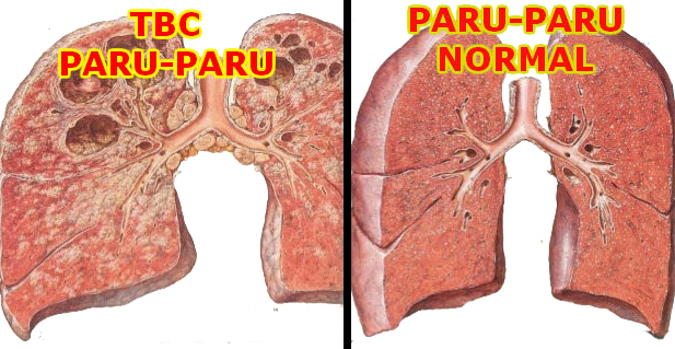 Cara Menyembuhkan Batu Empedu: Cara Mengobati Tuberkolosis Paru