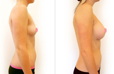 Antes e Depois Mamoplastia de Aumento Antes e Depois Mamoplastia de Aumento