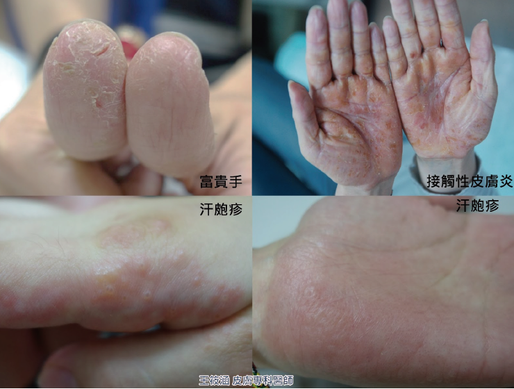 手部濕疹的表現:汗皰疹、富貴手、皮膚炎