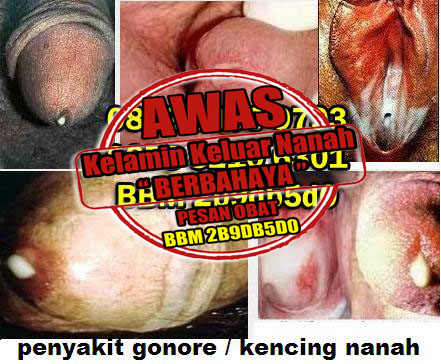 Cara Pengobatan Kencing Nanah Tanpa Antibiotik Cara Pengobatan Kencing Nanah Tanpa Antibiotik