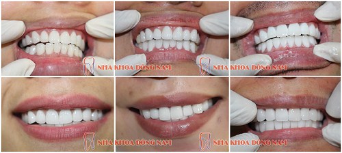BÀ BẦU CÓ LÀM RĂNG SỨ ĐƯỢC KHÔNG -1