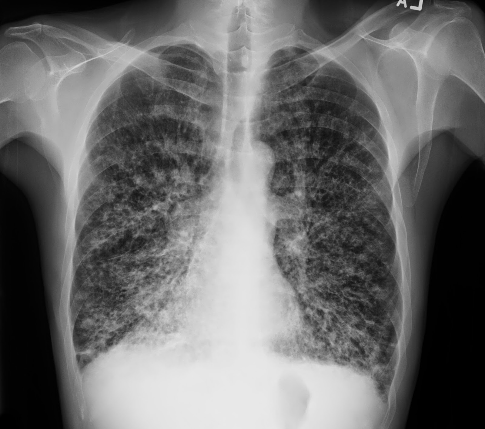 CXR 胸部x光判讀 bronchiectasis