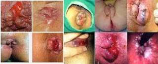 penyakit wasir obat wasir