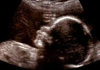 Fetus baby sonogram, abortion 