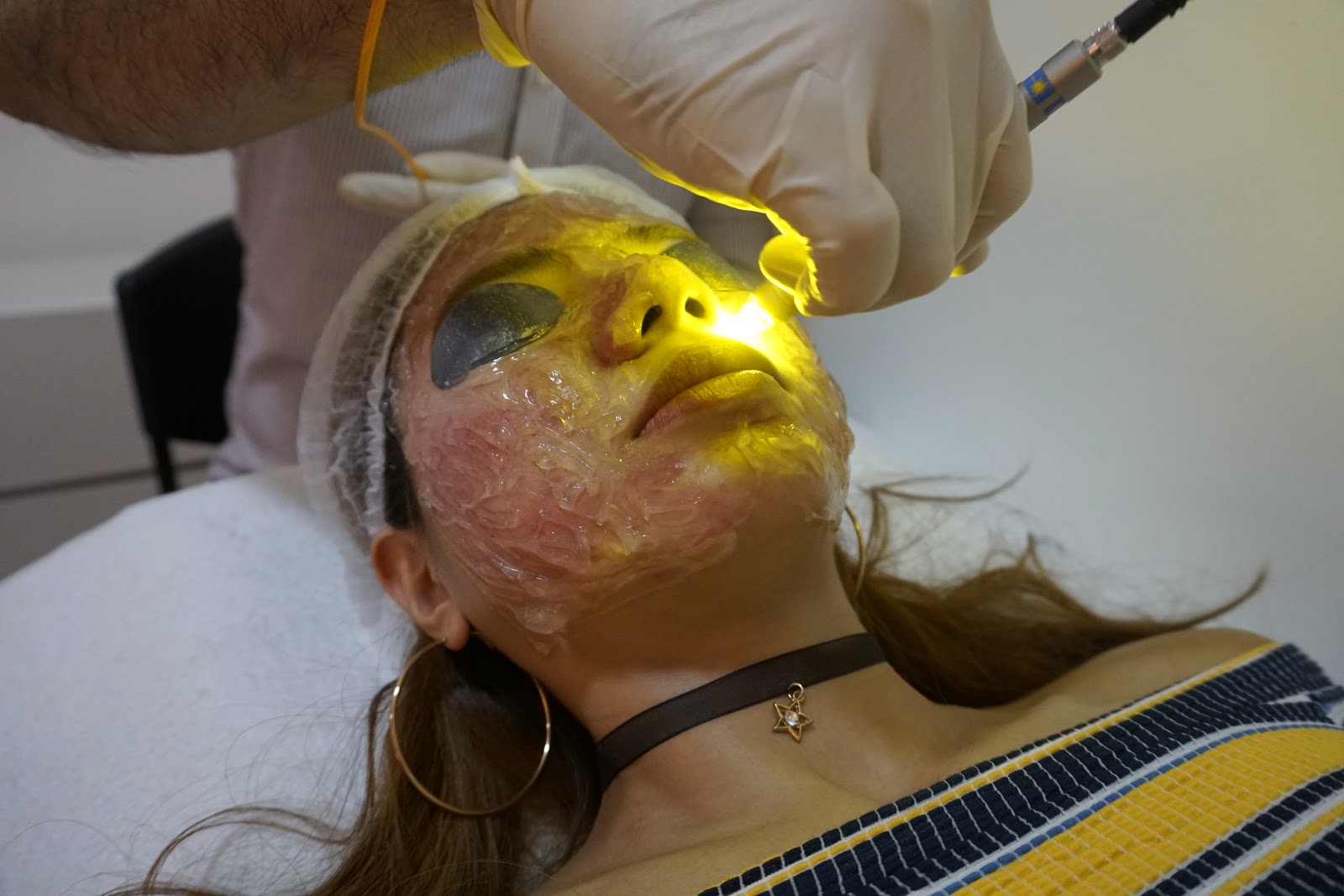 Laser for Acne Dual Yellow Laser Skin Gym SS2 J & D Learn to Blog