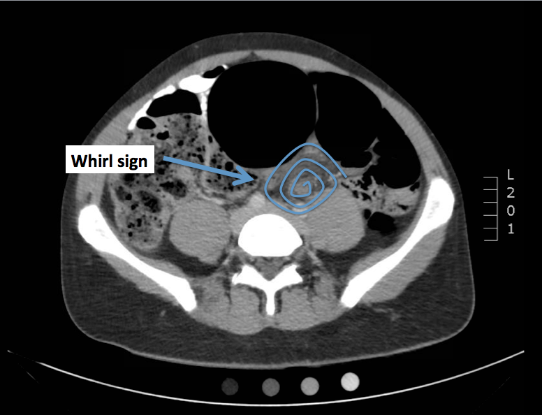 Emergency Medicine Visual Diagnosis Diagnosis Sigmoid Volvulus