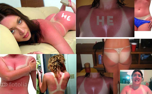 Surprising Parts Of Your Body That Can Get A Sunburn