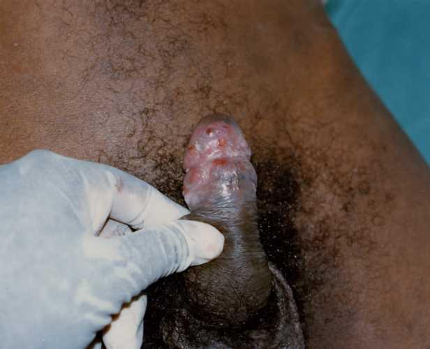 Hiv vaginal fluids touching my penis naked passion