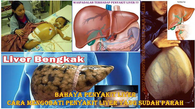 http://fikodominic.blogspot.com/2017/04/cara-mengobati-penyakit-liver-yang.html