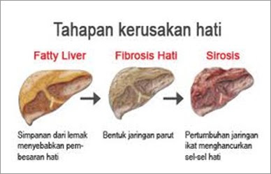 Solusi Atasi Penyakit Liver 100 % Yang Manjur Solusi Atasi Penyakit Liver 100 % Yang Manjur