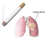 Ciri gejala kanker paru-paru