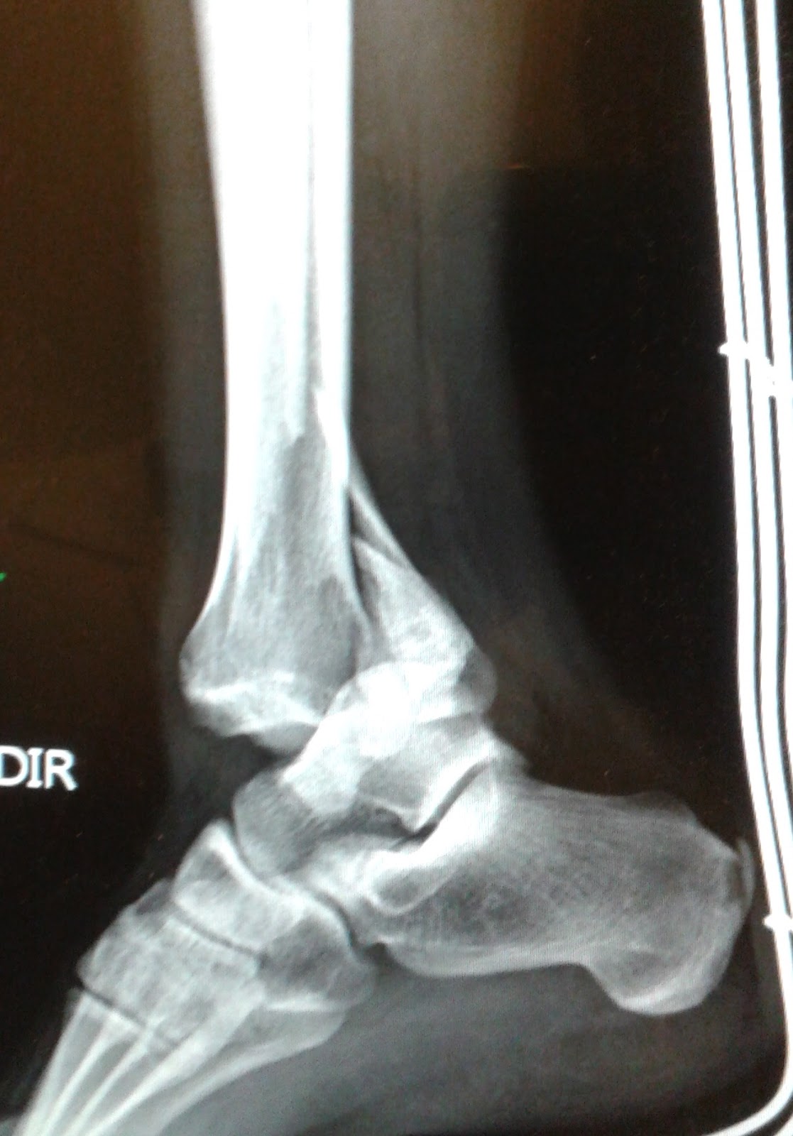 DICAS DE RADIOLOGIA: IMAGENS RADIOLÓGICAS - FRATURA FÍBULA
