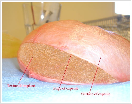 Capsular Contracture Breast Implant 96