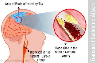 Manfaat Daun Karet Kebo Untuk Stroke gambar daun karet kebo, cara mengolah daun karet kebo, manfaat daun karet kebo bagi kesehatan, karet kebo untuk stroke, cara merebus daun karet kebo