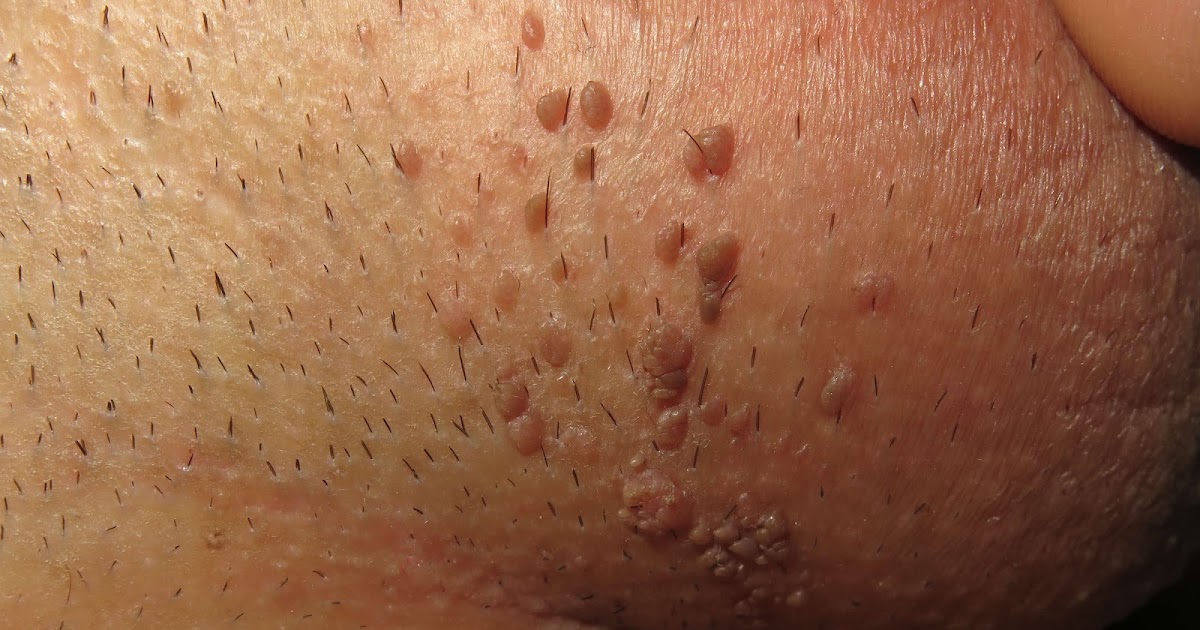 virus del papiloma labios genitales cream for papilloma