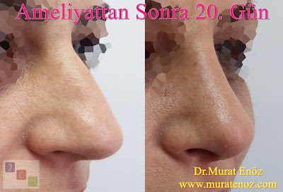 Female Nose Aesthetic Surgery - Nose Jobs For Women - Nose Reshaping for Women - Best Rhinoplasty For Women Istanbul - Female Rhinoplasty Istanbul - Nose Job Surgery for Women - Women's Rhinoplasty - Nose Aesthetic Surgery For Women - Female Rhinoplasty Surgery in Istanbul - Female Rhinoplasty Surgery in Turkey