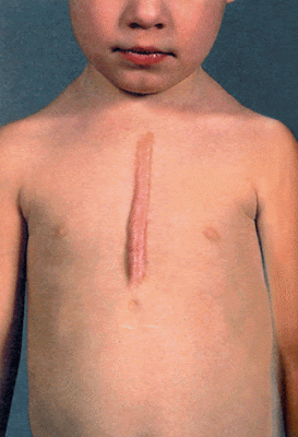 Pengobatan Keloid Ampuh Pengobatan Keloid Ampuh